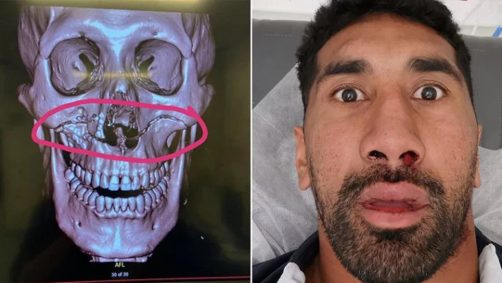 La impactante fractura de cráneo de una estrella de rugby: “Al menos mis dientes están intactos”