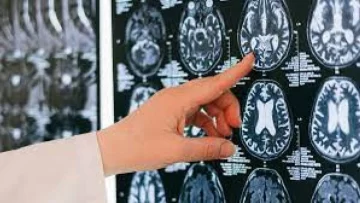 Los contagiados de Covid-19 podrían tener un daño “irreversible” en el cerebro, según un estudio
