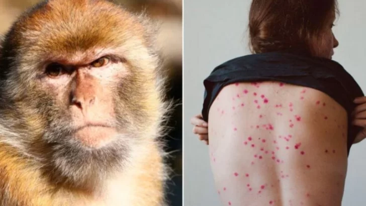 La OMS convocó a una reunión de emergencia ante el aumento de casos de viruela del mono