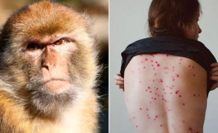 La OMS convocó a una reunión de emergencia ante el aumento de casos de viruela del mono