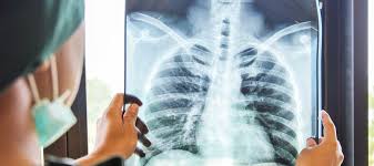 En Necochea no se han registrado contagios de tuberculosis en el sector público