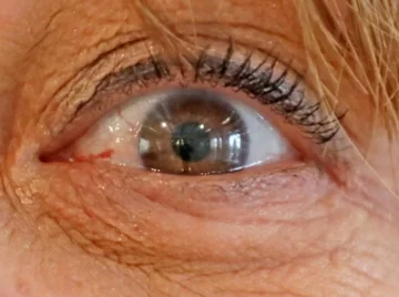 Emplean la IA para predecir el riesgo de alzheimer a través de las retinas