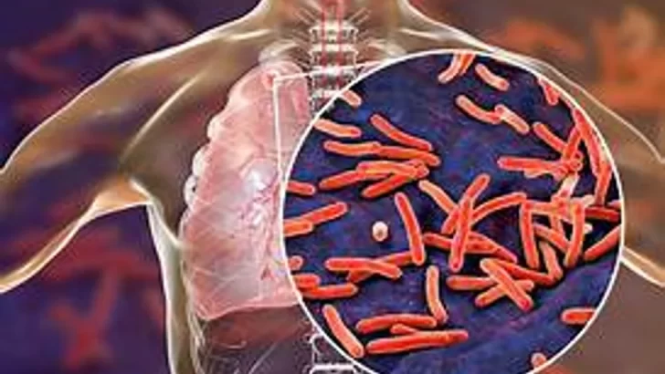 Aumentaron un 38% los casos de tuberculosis en Argentina