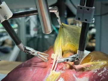 Un robot entrenado con IA y videos de cirugías operó una vesícula biliar sin ayuda humana