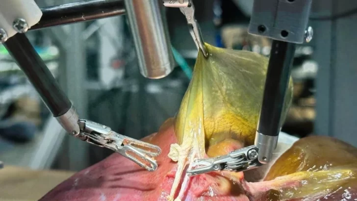 Un robot entrenado con IA y videos de cirugías operó una vesícula biliar sin ayuda humana