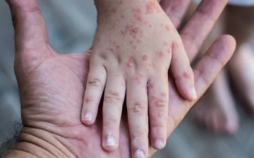 El Ministerio de Salud emitió un alerta por un posible brote de Sarampión