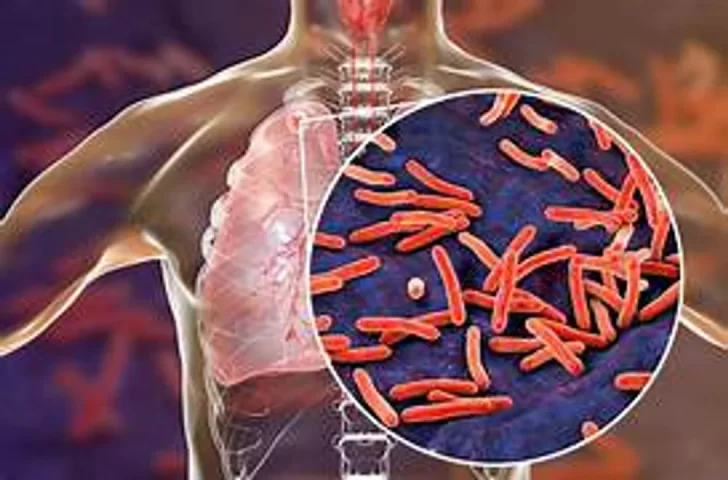 Aumentaron un 38% los casos de tuberculosis en Argentina