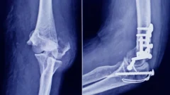 ANMAT advierte que un tornillo utilizado en cirugías traumatológicas es falso